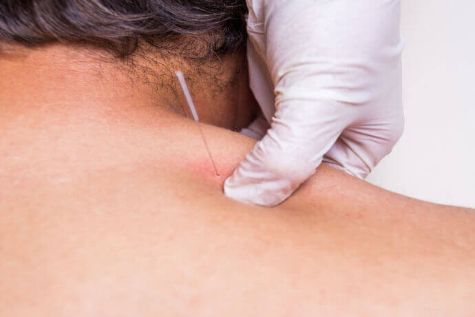 Dry-Needling Technique